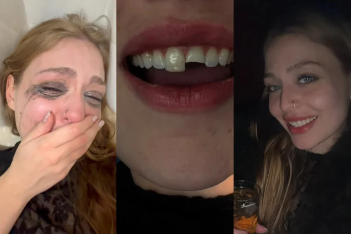 Jovem quebra dente em balada, busca dentista de madrugada e volta para a festa no PR